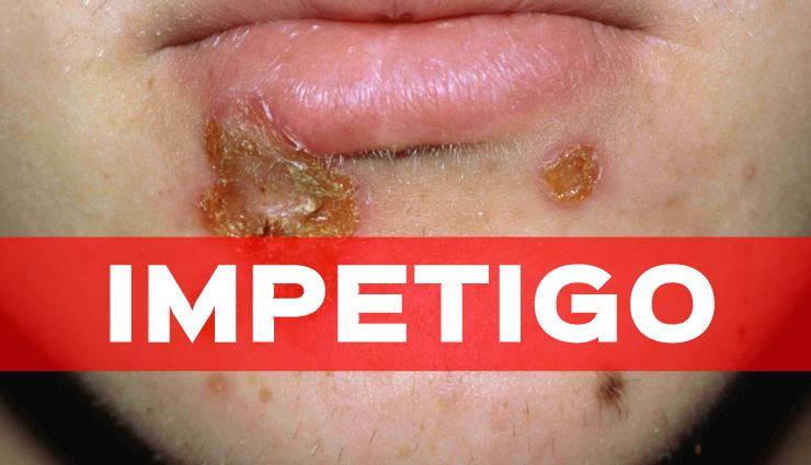 7 Natural Remedies for Impetigo