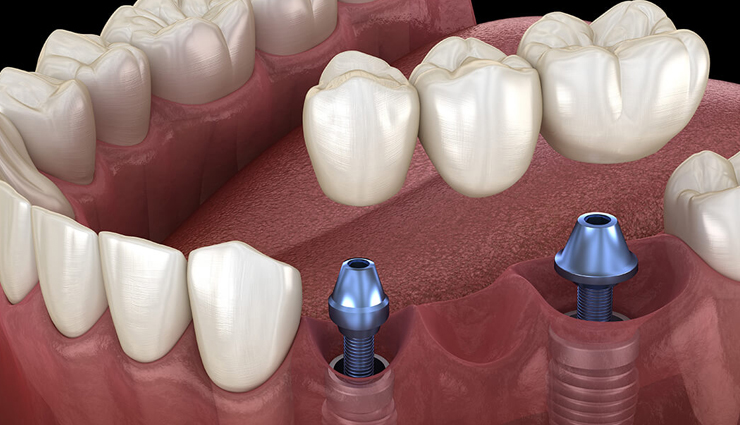 dental implants in shelby twp,implant dentistry services,shelby twp dental implants,confident smile solutions,dental implants for smiles,implant dentist shelby twp,implant dentistry experts,reviving smiles with implants,best dental implants shelby twp,implant solutions for smiles,confidence-boosting implants,advanced implant dentistry,smile restoration with implants,shelby twp implant dentistry,dental implant specialists,implant dentists for smiles,revitalize your smile,implant solutions for confidence,expert implant dental care,implant smile transformation
