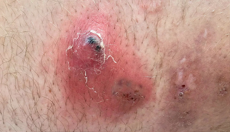 tea tree oil for acne,beauty benefits of tea tree oil,amazing benefits of tea tree oil for skin,tea tree oil acne treatment,natural remedy for acne: tea tree oil,clear skin with tea tree oil,how to use tea tree oil for acne,tea tree oil skincare for acne-prone skin,tea tree oil for clear and blemish-free skin,get rid of acne with tea tree oil