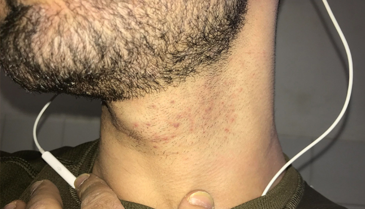 7 Tips for Men To Help You Reduce Ingrown Hair