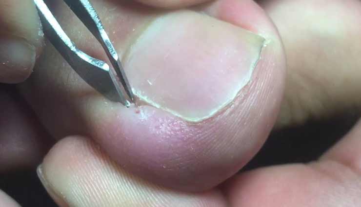 क्या आपके भी पैर के नाखून बढ़ रहे अंदर की तरफ, इन उपायों की मदद से पाए राहत 