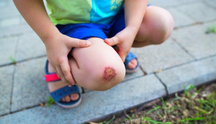 घाव ठीक करने में अंग्रेजी दवाइयों से पांच गुना असरदार है ये घरेलू उपाय home remedies to get rid of injury,Health tips,wound healing home remedies,gharelu nuskhe