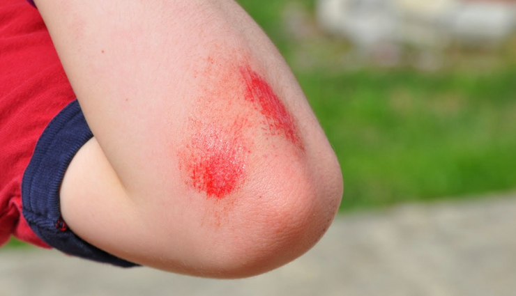 tips to heal bruises and swelling in minutes,healthy living,Health tips