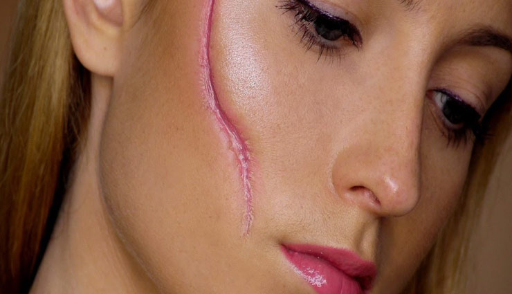 बचपन की चोट के निशान को मिटाएँ इन घरेलू उपयों की मदद से