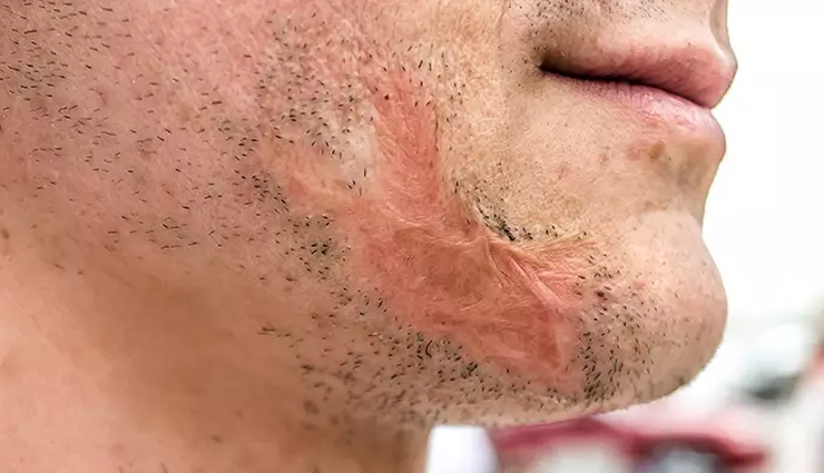 क्या आपके चेहरे पर भी हैं पुरानी चोट के निशान, इन 10 उपायों से करें इन्हें दूर 