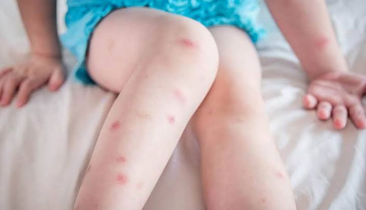 insect bite,home remedies for insect bite,home remedies,Health tips,fitness tips