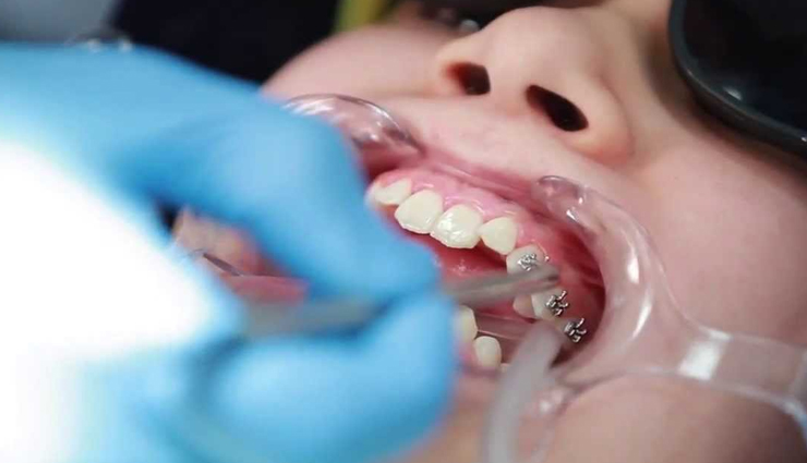 braces,child ready for braces,ways to get your child ready for braces,teeth health,Health,Health tips