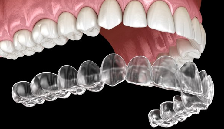 invisalign treatment,benefits of invisalign,invisalign braces,invisalign clear aligners,invisalign orthodontic treatment,invisalign for teeth alignment,invisalign vs traditional braces,how does invisalign work,invisalign process,invisalign consultation,invisalign maintenance,invisalign cleaning,invisalign cost,invisalign financing options,invisalign before and after,invisalign success stories,invisalign for adults,invisalign for teens,invisalign treatment tips