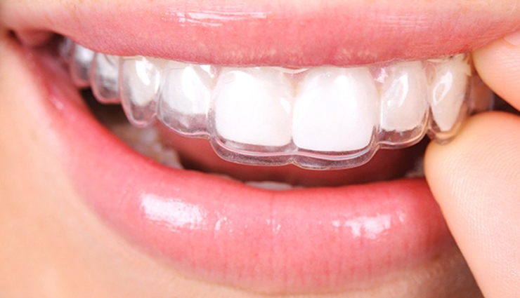 invisalign treatment,benefits of invisalign,invisalign braces,invisalign clear aligners,invisalign orthodontic treatment,invisalign for teeth alignment,invisalign vs traditional braces,how does invisalign work,invisalign process,invisalign consultation,invisalign maintenance,invisalign cleaning,invisalign cost,invisalign financing options,invisalign before and after,invisalign success stories,invisalign for adults,invisalign for teens,invisalign treatment tips