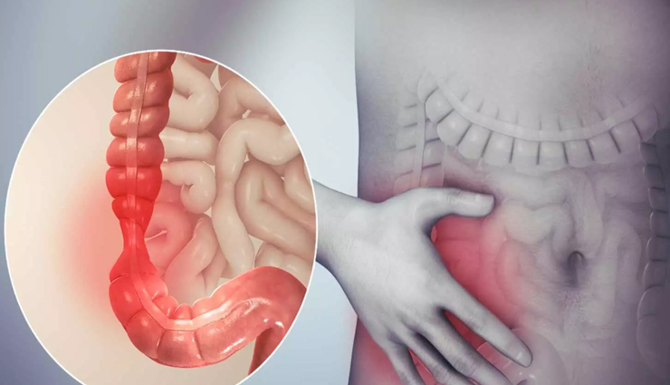 12 Ways To Treat Irritable Bowel Syndrome at Home
