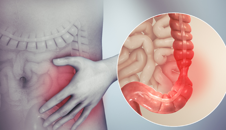 Understanding Irritable Bowel Syndrome (IBS) and 10 Effective Home Remedies for Relief