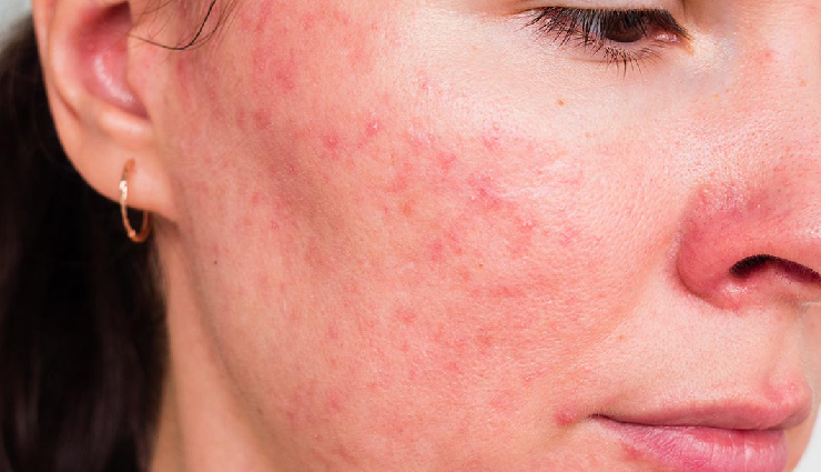 benefits of tea tree oil for skin,tea tree oil for acne,tea tree oil skin care,tea tree oil uses,antibacterial tea tree oil,tea tree oil for oily skin,tea tree oil for infections,natural deodorant tea tree oil