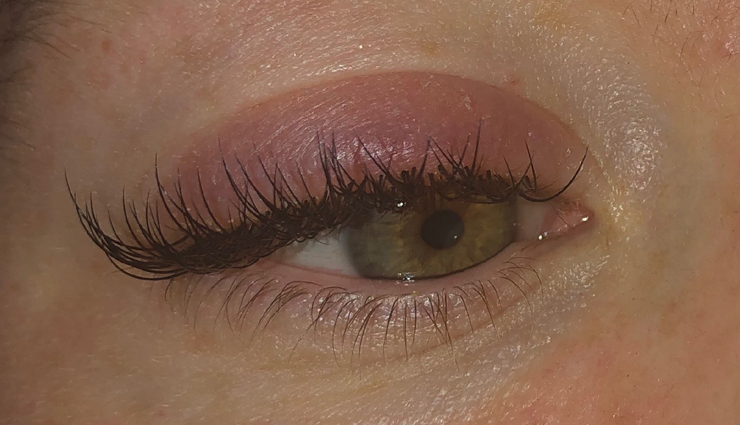 eyelash extension side effects,beware of eyelash extension risks,potential problems with lash extensions,adverse effects of using lash extensions,eyelash extensions and their drawbacks,negative consequences of lash extension use,health concerns with eyelash extensions,side effects of prolonged lash extension use,risks of wearing eyelash extensions,eyelash extension complications to watch out for