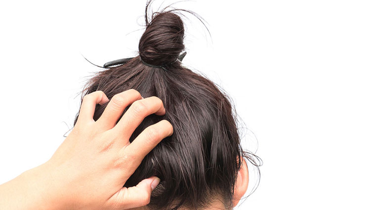 itchy scalp,home remedies for itchy scalp,home remedies