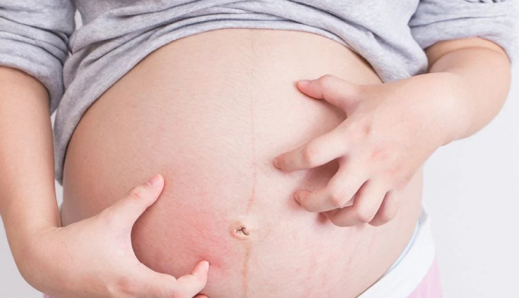 7 Effective Home Remedies To Treat Itchy Belly During Pregnancy