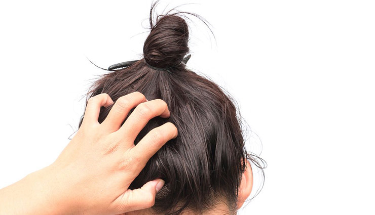 itchy scalp during monsoon,home remedies,home remedies for itchy scalp,monsoon hair care tips,beauty tips