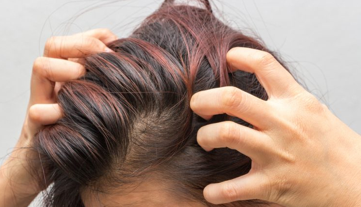 Here are Few Home Remedies For an Itchy Scalp