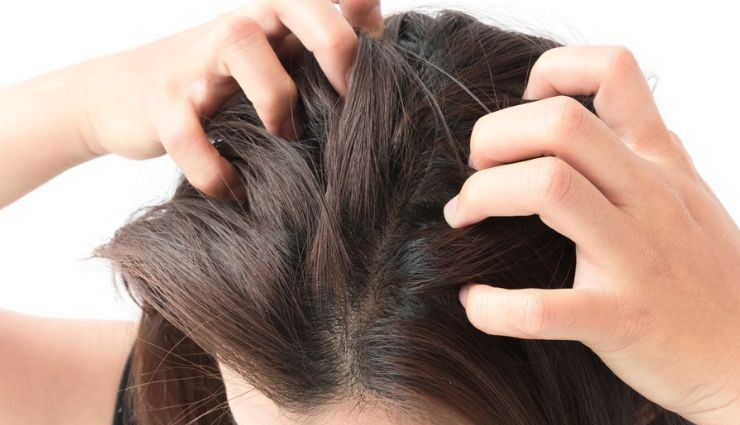 9 Home Remedies That are Effective To Treat Itchy Scalp