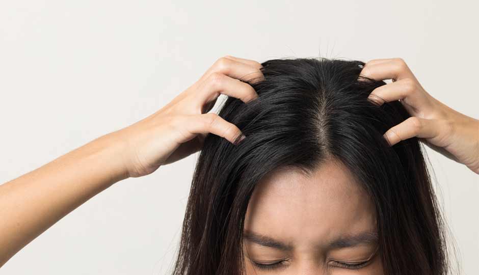 7 Effective Home Remedies to Treat Itchy Scalp in Monsoon