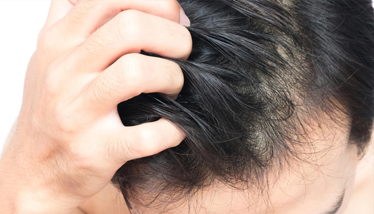 5 Easiest Ways To Get Rid of Itchy Scalp During Monsoon