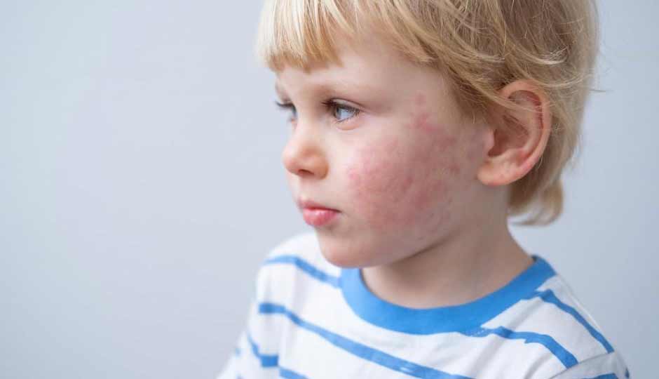 10 Effective Home Remedies to Treat Itchy Skin in Kids in Winter