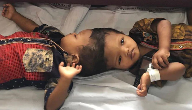 लिम्का बुक में दर्ज हुई सिर से जुड़े दो बच्चों को अलग करने की सर्जरी, दो साल चले इलाज के बाद मिली थी सफलता