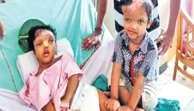 jagga and ballia,associated with head,healthy,complex surgery,aiims,odisha,record,surgery recorded in limca book,to separate head,weird news in hindi