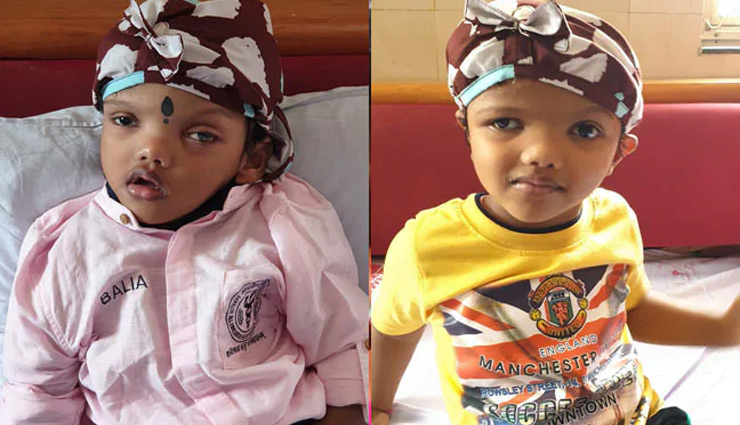 jagga and ballia,associated with head,healthy,complex surgery,aiims,odisha,record,surgery recorded in limca book,to separate head,weird news in hindi