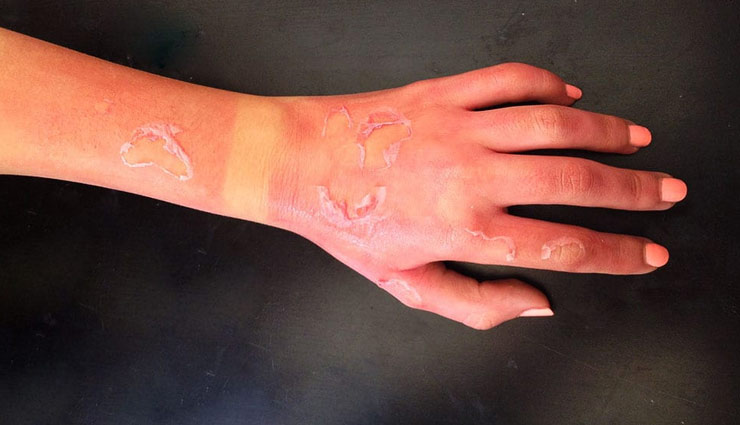 पटाखों की जलन ना पड़ जाए भारी, ले इन टिप्स की मदद Health tips,diwali special,burn fireworks,remedies of skin burn