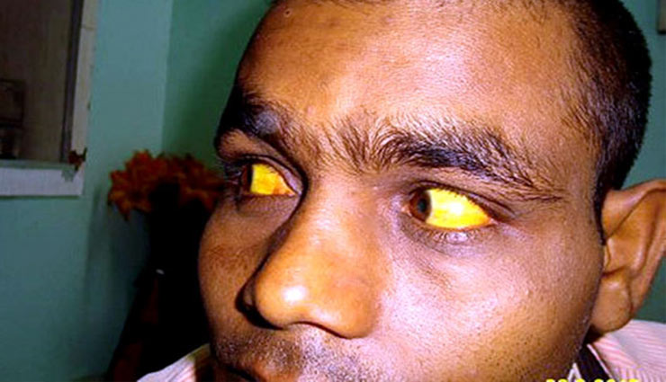जानलेवा बीमारी है पीलिया, ये 5 चीजें करेंगी जड़ से इलाज 
