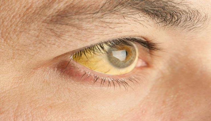 Health tips,health tips in hindi,jaundice,jaundice relief foods