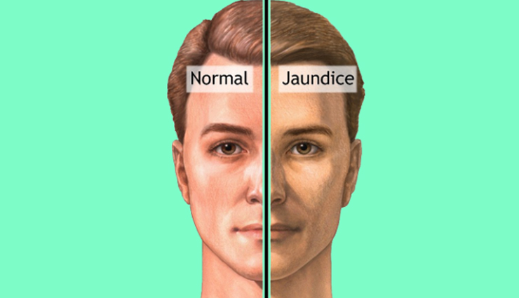 5 Home Remedies Effective For Jaundice