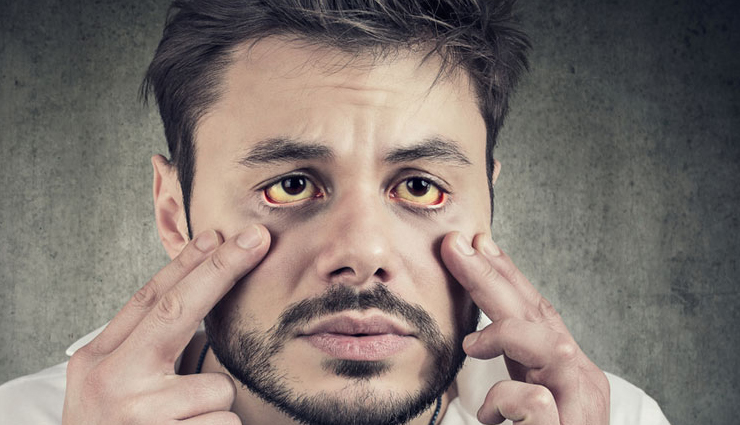 8 Home Remedies That are Helpful in Treating Jaundice