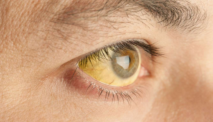 10 Powerful Superfoods to Combat Jaundice