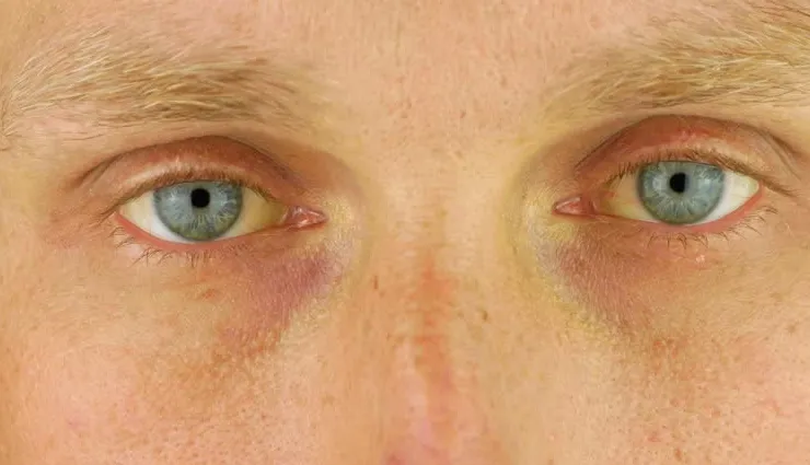 early signs of liver damage,symptoms of liver failure,causes of liver disease,liver health tips,hepatitis b and c effects,cirrhosis symptoms,alcohol-related liver damage,malnutrition and liver health,how to protect liver,warning signs of liver problems