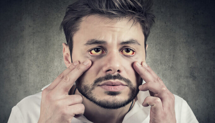 reasons and effects of jaundice,jaundice,Health tips,fitness tips