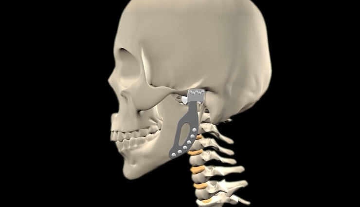 अब जयपुर में ही कृत्रिम जबड़ा लगवा सकेंगे ब्लैक फंगस के मरीज, डेढ़ से दो लाख रुपए तक आएगा खर्चा
