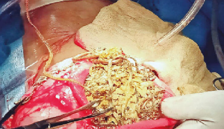 महिला के पेट से निकले 5-10 रुपये के 90 सिक्के और 1.5 किलो जूलरी