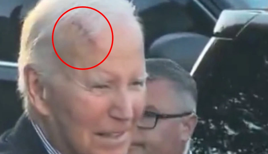 जो बाइडेन के माथे पर उभरा गहरा निशान, डॉक्टरों ने बताया असली कारण