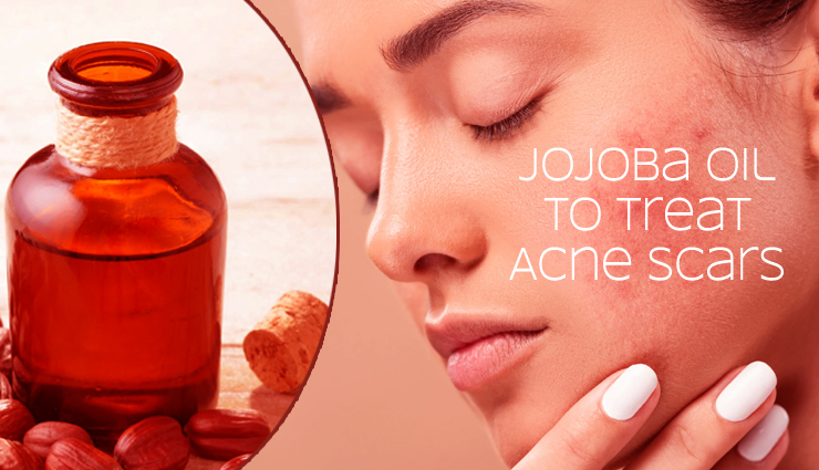 Different Ways To Use Jojoba Oil To Treat Acne Scars