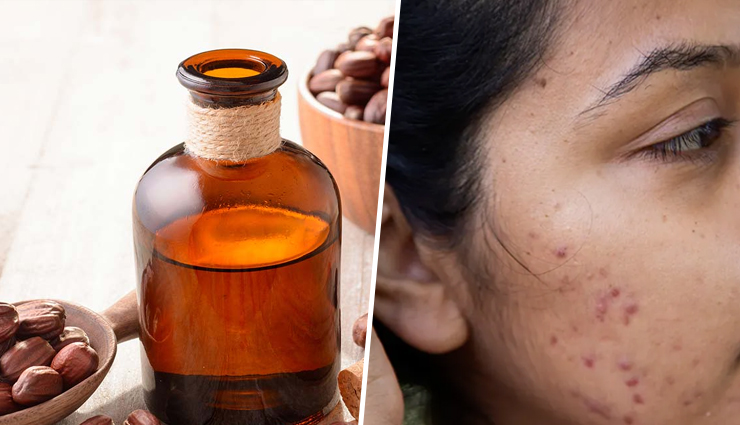 10 DIY Ways to Use Jojoba Oil to Treat Acne Scars