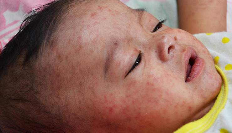 मुंबई में तेजी से फैल रहा खसरा, जानें क्या हैं लक्षण और कैसे होगा बचाव?