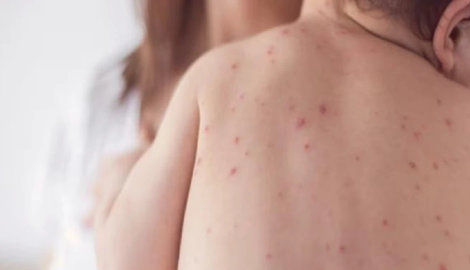 दुनिया के सबसे बड़े मुस्लिम देश में खसरे का कहर, हलाल वैक्सीन की उठी मांग