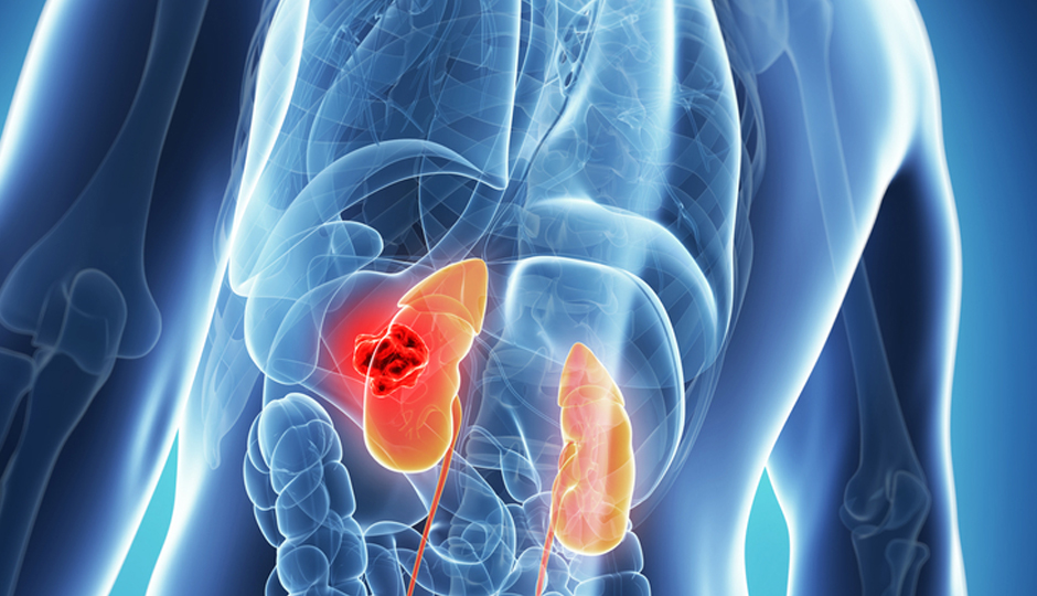 kidney cancer symptoms,renal cell carcinoma,signs of kidney cancer,kidney tumor,kidney function problems,urinary tract symptoms,lower back pain,kidney cancer early detection,kidney health,kidney cancer risk factors,silent kidney cancer,kidney cancer warning signs
