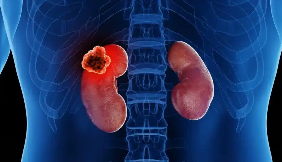 5 Major Signs of Kidney Cancer You Must Know