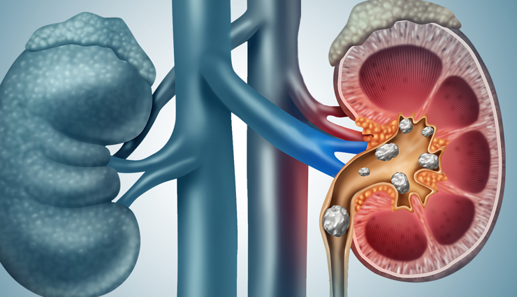 6 High Oxalate Foods To Avoid Kidney Stone