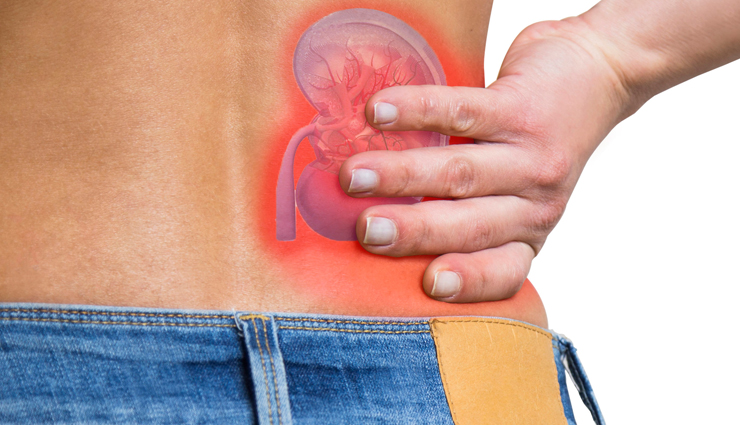 6 Natural Remedies To Help You Recover from Kidney Stones