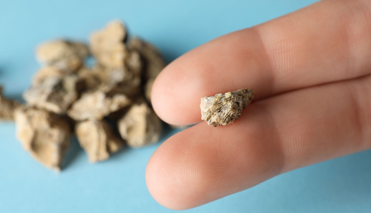 10 Home Remedies To Help You Treat Kidney Stones