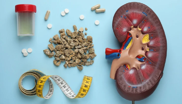 13 Foods That are Helpful in Kidney Stone Treatment