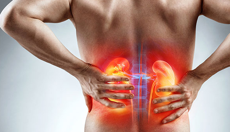 10 Natural Ways To Get Rid of Kidney Stones